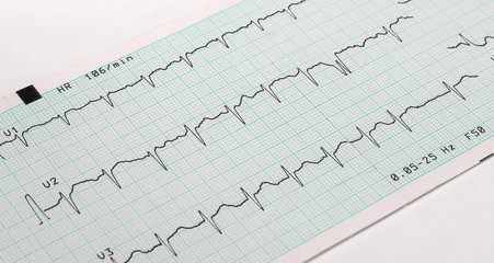 EKG arrhythmia absoluta, printout background - obrazy, fototapety, plakaty