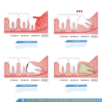 several common problems has impact from wisdom teeth, infection, crowding, erosion cavity and cysts..
