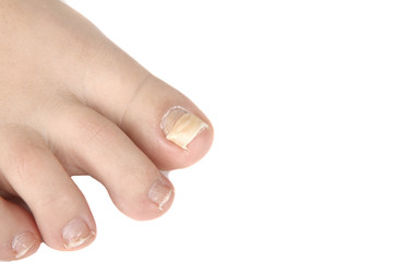 reconstruction nail, nail that went down with a finger - repair