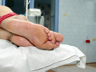 osteomyelitis of the big toe