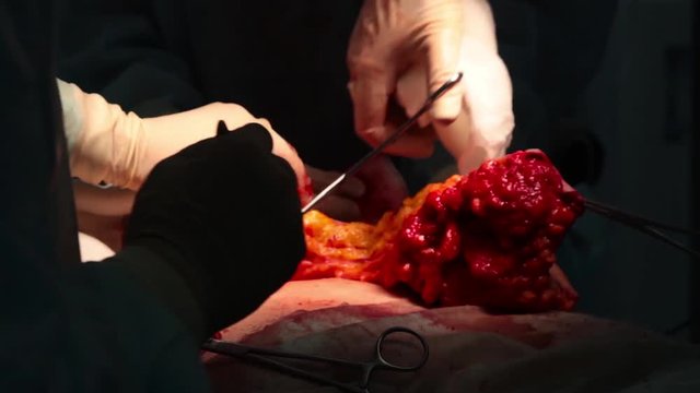 Doctor cuts off the excess pieces of human flesh during surgery