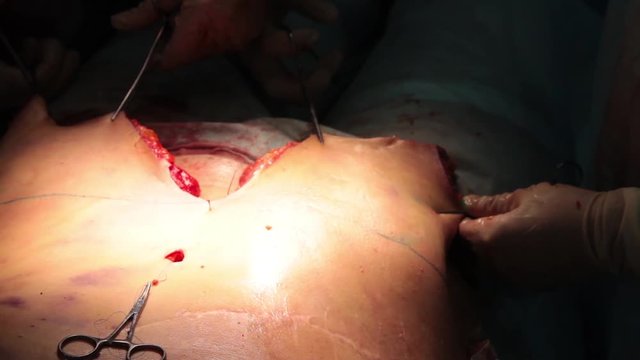 Doctor Marker cutting line during a tummy tuck