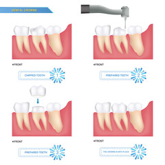 infographics crowns are used to cover a damaged tooth, process of dental crowns