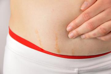 Woman showing stretch marks