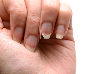Broken Finger Nail - Female Hand