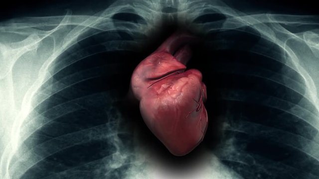 Sick Human Heart Inside Of X-Ray