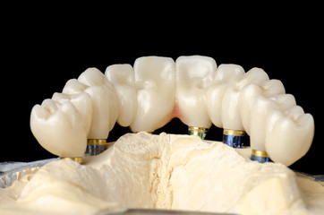 Monolithic zirconia restorations full arch implant