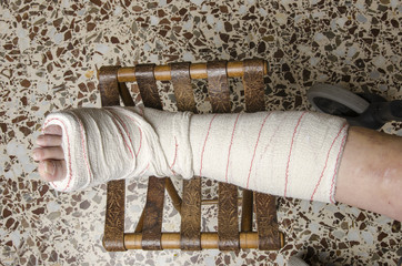 Woman with her broken leg. Arm in a cast.