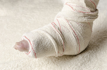Fototapeta premium Woman with her broken leg. Arm in a cast.