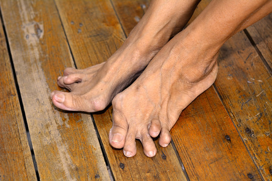 Old woman's foot deformed from rheumatoid arthritis