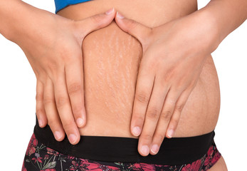 stretch marks