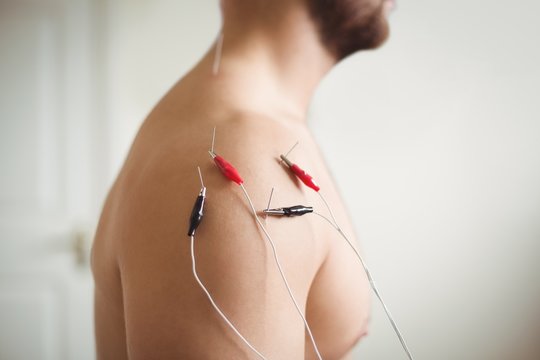 Close-up of patient getting electro dry needling