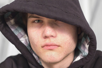 horizontal head shot of a young caucasian teenager with acne looking angry and sad wearing a hoodie that covers one eye.