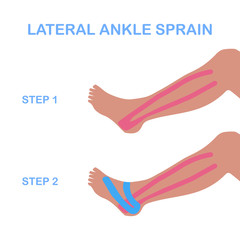 Lateral ankle sprain. Correct kinesiology taping. Vector illustration.