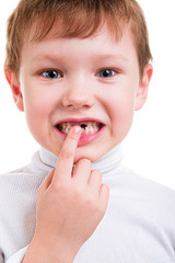 boy showing his missing milk teeth