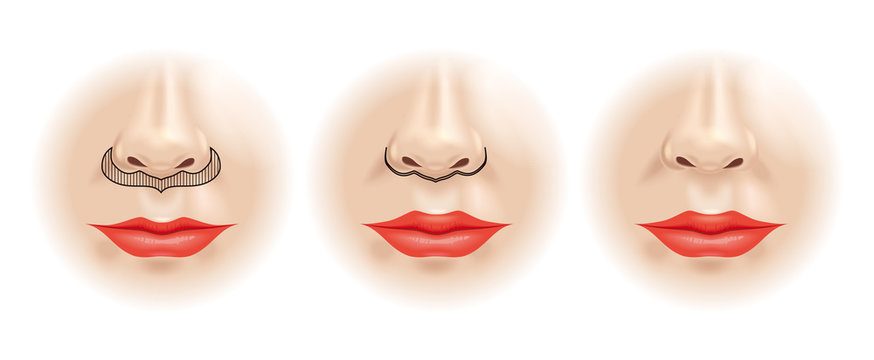 scheme correction of the upper lip. plastic surgery