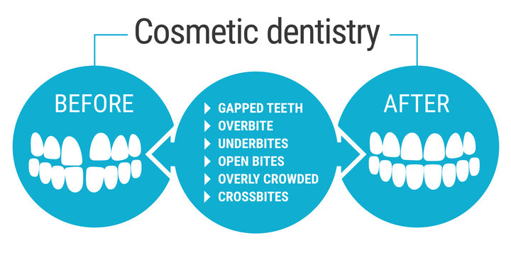 Cosmetic Dentistry Before After. Medical Infografics: Dental Services. Cosmetic Dentist Before And After. Dental Design Over White Background Vector Illustration