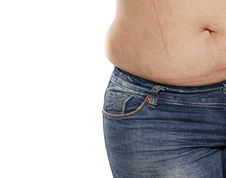 stretch marks on the stomach of a fat woman in jeans on a white background