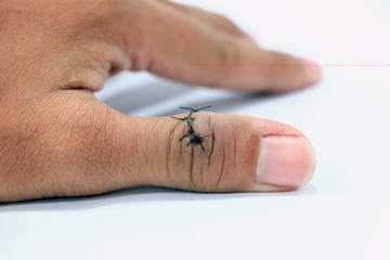 Close-up of wounded and stitched on thumb finger.