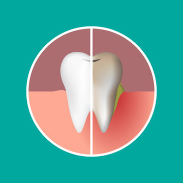 Vector illustration of a tooth before and after treatment. Sick and healthy tooth.