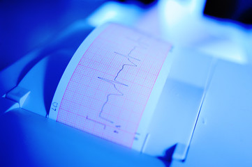 Printing of cardiogram report coming out from Electrocardiograph in labour ward