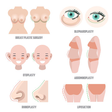 Plastic surgery set. Before ans after surgery example. vector illustrations of otoplasty; blepharoplasty; rhinoplasty; liposuction; abdominoplasty and breast surgery.