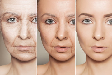 anti-aging procedures on caucasian woman face