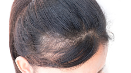 Woman serious hair loss problem for health care shampoo and beau