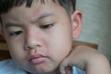 Close up image of  boy's body suffering severe urticaria, nettle