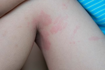 Close up image of  boy's body suffering severe urticaria, nettle