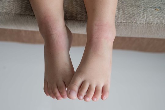 Close up image of  boy's body suffering severe urticaria, nettle