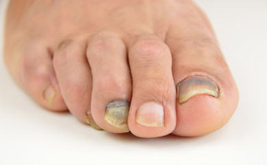 hematoma in a nail