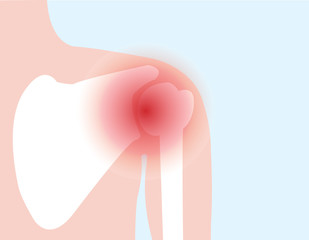 illustration vector of shoulder bone and joint pain - obrazy, fototapety, plakaty