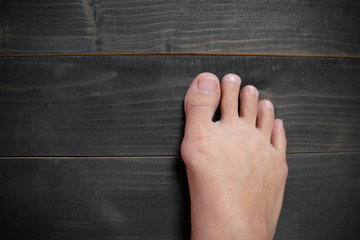 Hallux valgus, bunion in foot