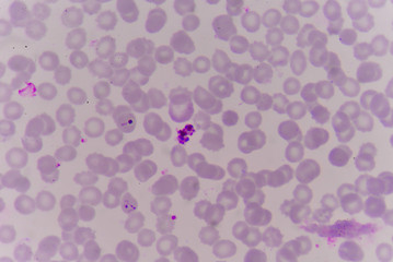 blood films for Malaria parasite.show malaria pigment.