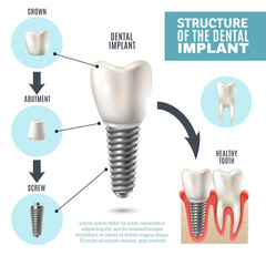 Dental Implant Structure Medical Infographic Poster  - obrazy, fototapety, plakaty