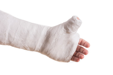 Arm plaster / fiberglass cast  with the thumb extended