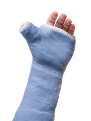 Arm plaster / fiberglass cast  with the thumb extended