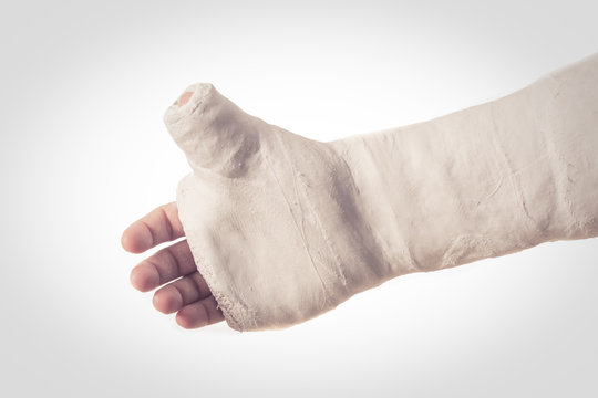 Arm Plaster / Fiberglass Cast  With The Thumb Extended