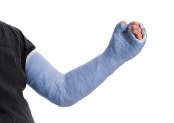 Young man wearing a blue long arm plaster  fiberglass cast