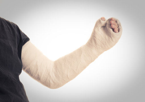 Young man wearing a long arm plaster / fiberglass cast