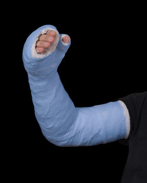 Young man wearing a blue long arm plaster fiberglass cast