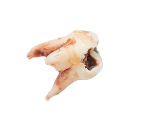extracted tooth on a white background