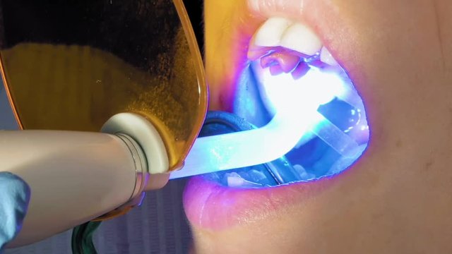 Woman at dentist clinic gets dental treatment to fill a cavity in a tooth. Dental restoration and material polymerization with UV light. Odontic and mouth health is real protection from caries decay.
