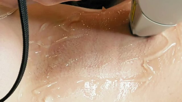 Woman gets laser hair removal treatment underarm. Modern permanent epilation procedure.