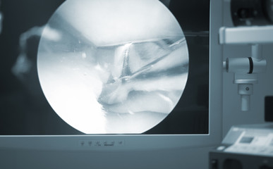 Arthroscopy surgery screen