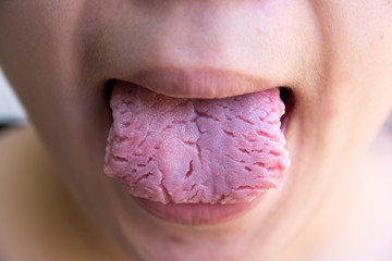 Bacterial infection disease tongue,The tongue is thrush.Tongue w