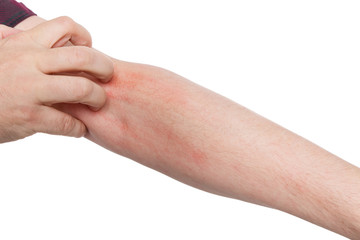 Mann kratzt sich am Arm, Krätze oder Dermatillomanie