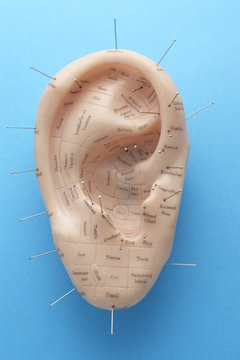 Acupuncture pins in model ear