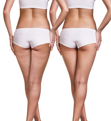 Female buttocks before and after cellulite - 129890556